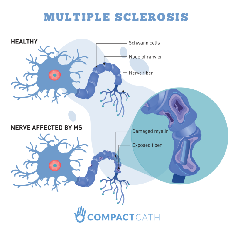 Bladder Management with Multiple Sclerosis CompactCath