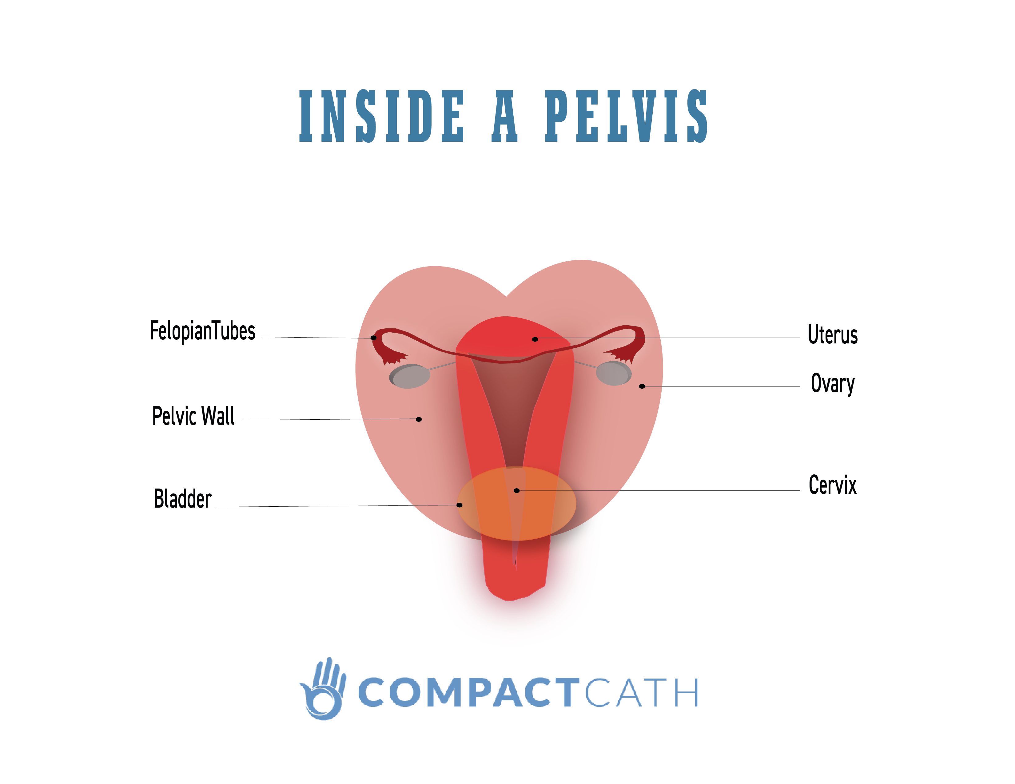 hysterectomy-pelvis