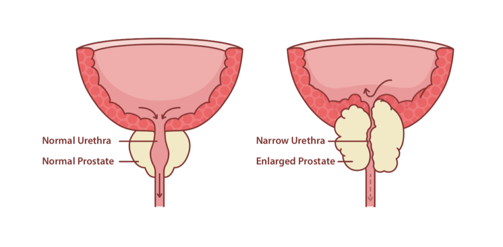BPH, benign prostatic hyperplasia, enlarged prostate, prostate enlargement 