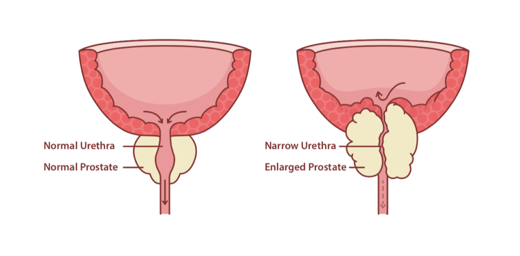 how to reduce prostate enlargement naturally