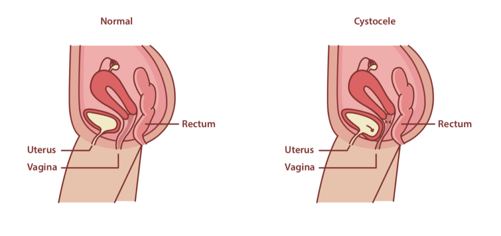 ladder prolapse, anterior prolapse, cystocele Pelvic Organ Prolapse