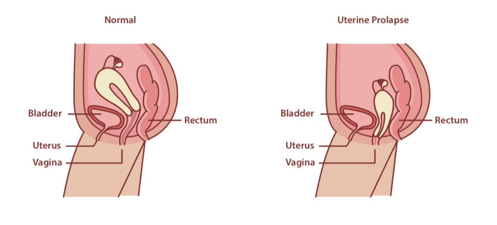 Pelvic Organ Prolapse uterine prolapse, the prolapse of the uterus