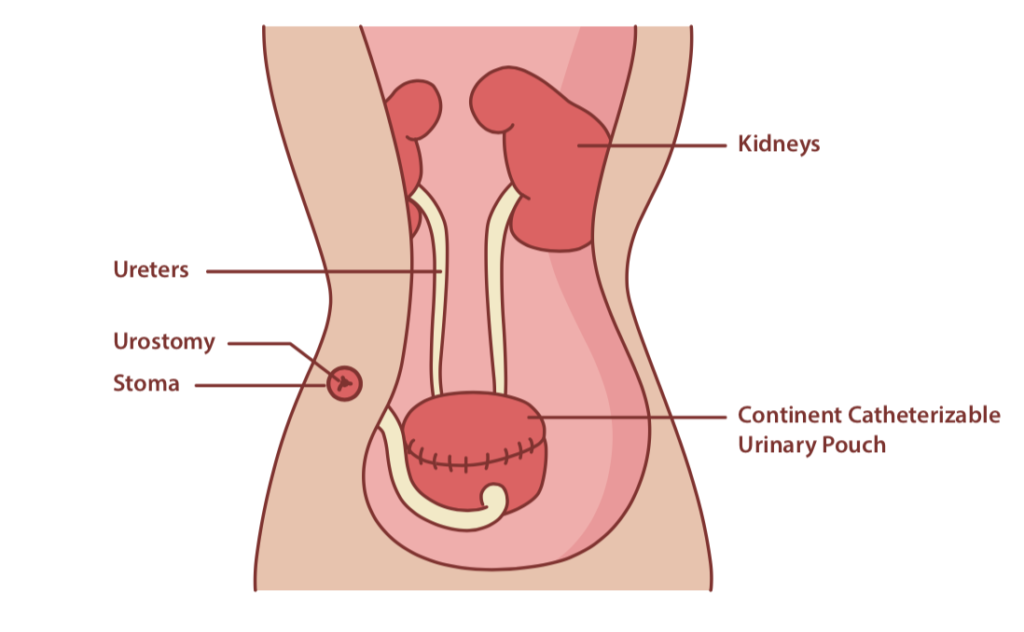 Urostomy Care: How to Care for an Indiana Pouch, Ileal ...
