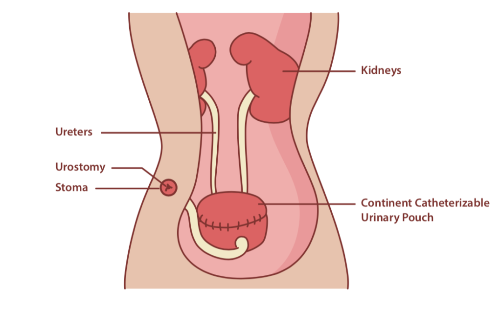 urostomy, stoma, indiana pouch, kock pouch, continent urine pouch, urinary diversion, urinary diversion surgery